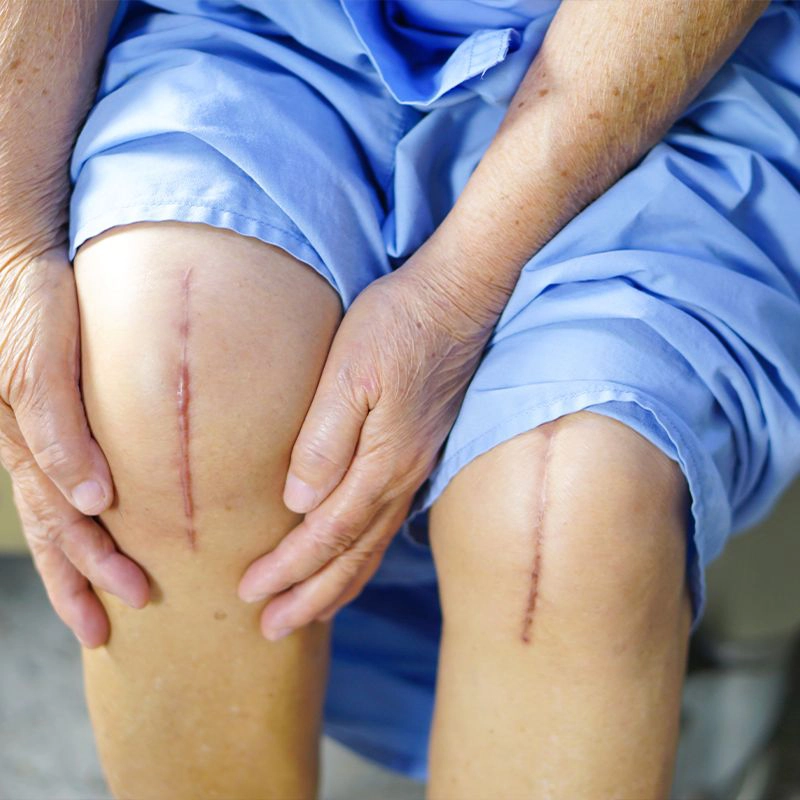 Knee Replacement Surgery in Hyderabad: When Do You Need It?