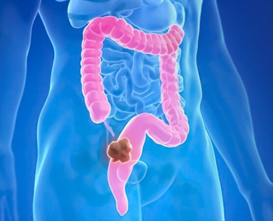 Early Signs of Colon Cancer You Should Never Ignore