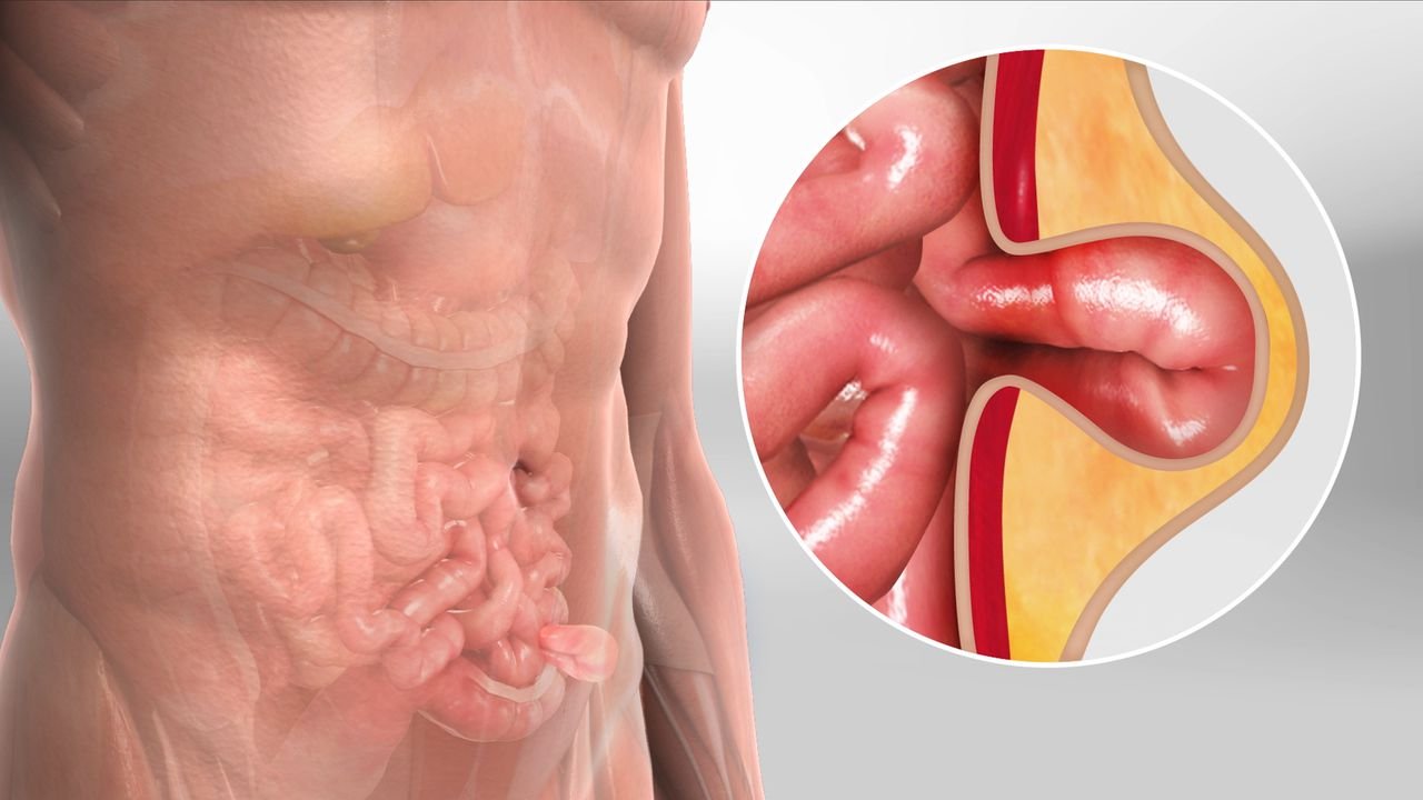 Hernia Surgery in Hyderabad: Symptoms, Types and Treatment